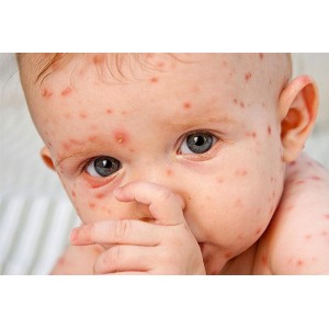 Bệnh phỏng rạ cách nhận biết và tuyệt chiêu đẩy bay phỏng rạ nhanh, hiệu quả nhất Bệnh phỏng rạ cách nhận biết và tuyệt chiêu đẩy bay phỏng rạ nhanh, hiệu quả nhất